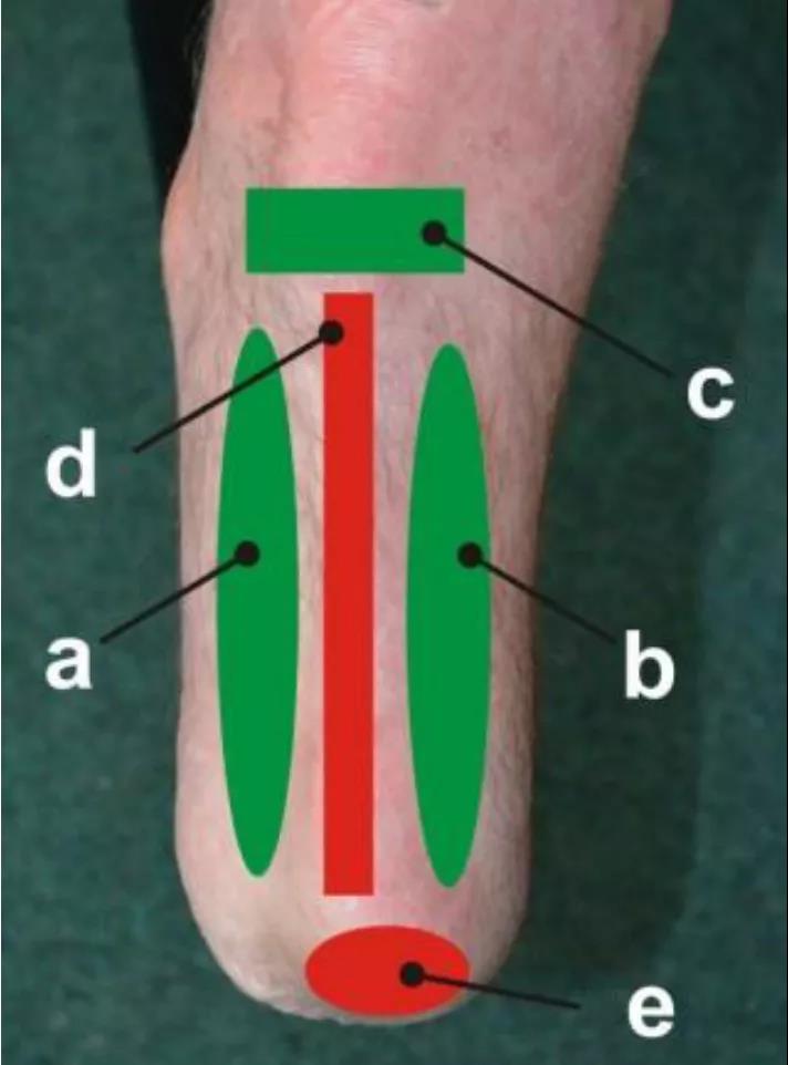 TACTILUS 柔性壓力分布系統應用于假肢研究中
