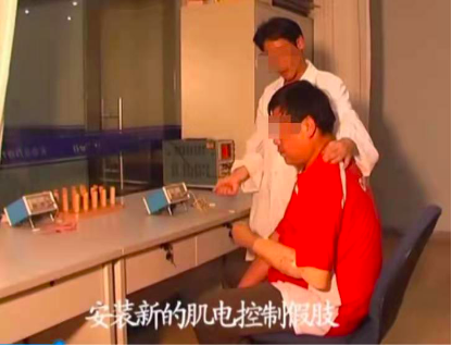 肌電假肢——運動員劉先生