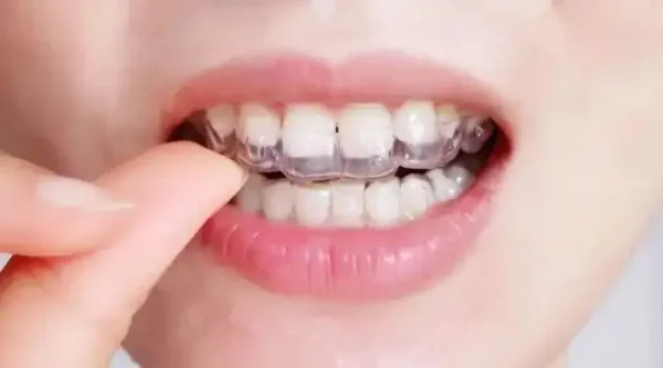 正雅隱形矯正器