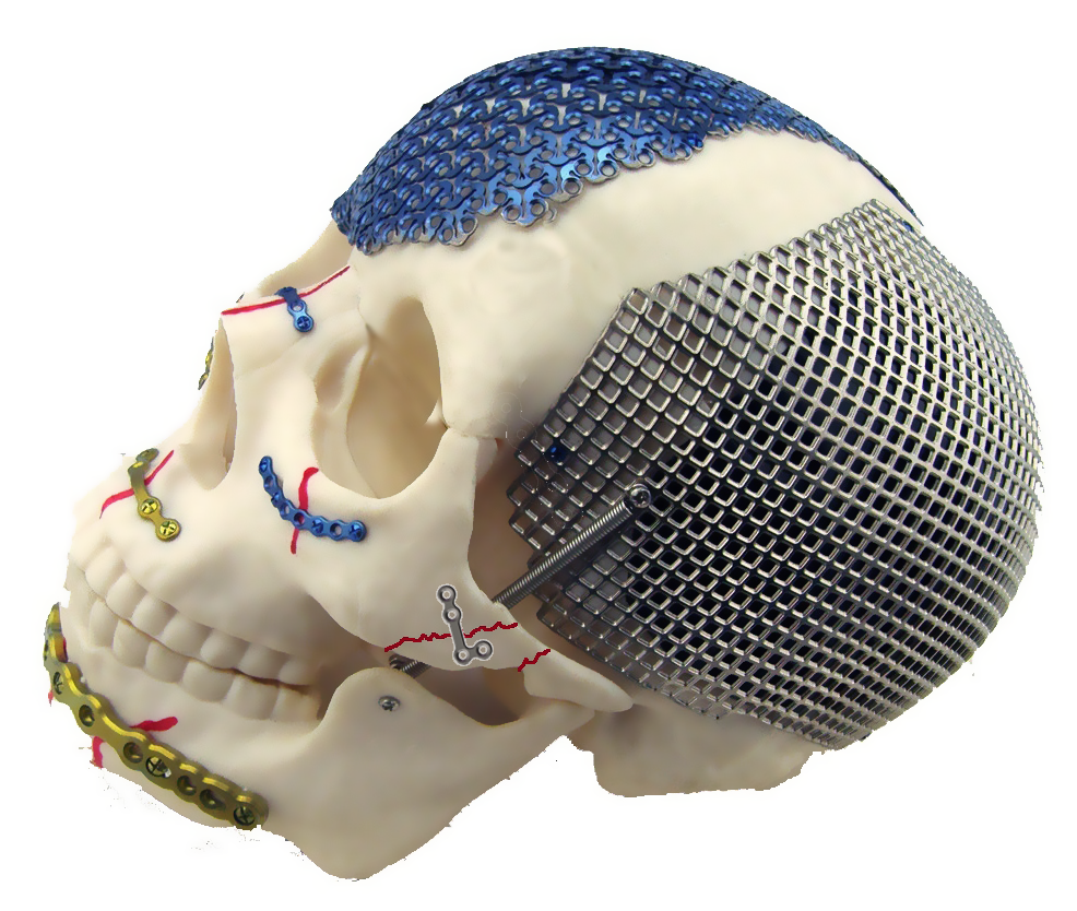 第1講 鈦及鈦合金材質(zhì)植入物的優(yōu)缺點(diǎn)分析