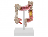 大腸疒變縮小模型