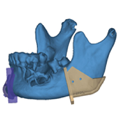 骨科定位器工作原理及臨床應(yīng)用解析