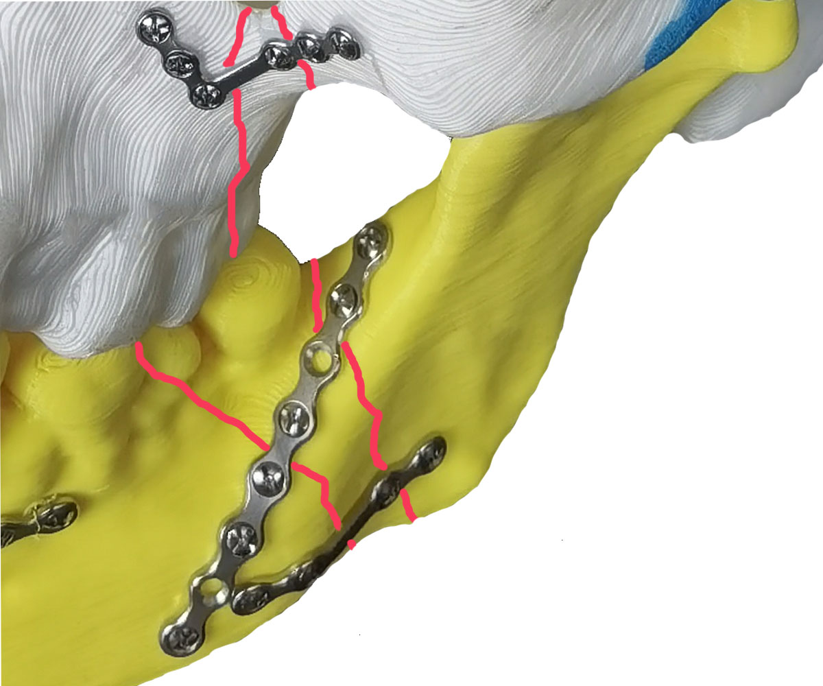 2.0mm系列小型鈦板