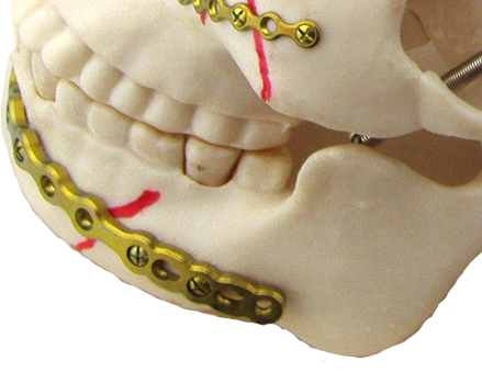 2.7mm系列下頜重建鈦板