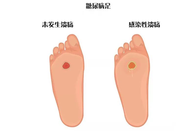 med压力怎么弄如何通过足底压力分布测试系统发现早期糖尿病足？_https://www.jmylbn.com_新闻资讯_第2张