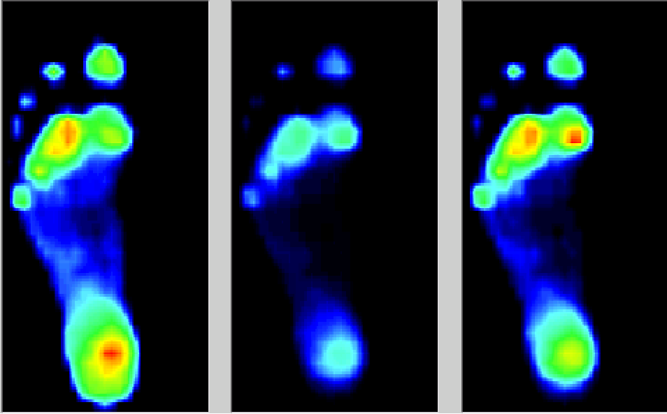 med压力怎么弄如何通过足底压力分布测试系统发现早期糖尿病足？_https://www.jmylbn.com_新闻资讯_第6张