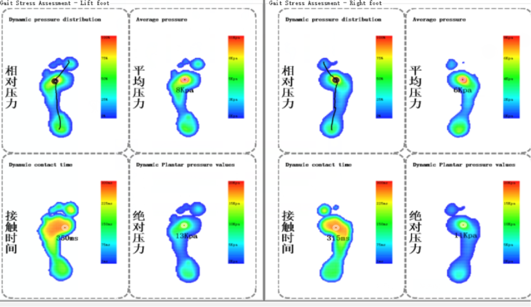 med压力怎么弄如何通过足底压力分布测试系统发现早期糖尿病足？_https://www.jmylbn.com_新闻资讯_第8张