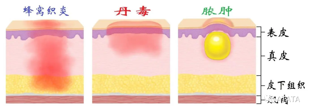 毒是什么毒?得了丹毒怎么办?看完秒懂!