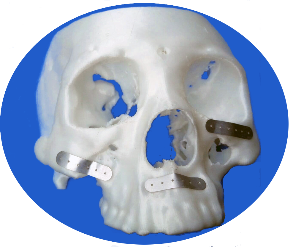 項(xiàng)目介紹1：鋼板塑型片