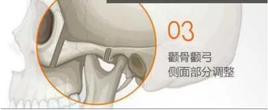 顴骨內(nèi)推03.png