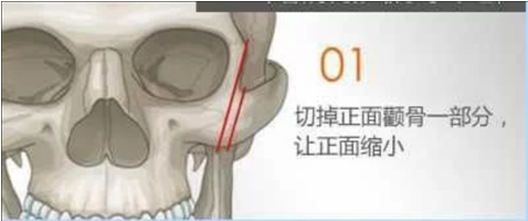 顴骨內(nèi)推01.png