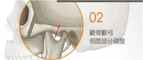顴骨內(nèi)推02.png