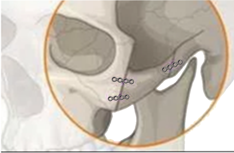 項(xiàng)目介紹2：顴骨旋轉(zhuǎn)內(nèi)推術(shù)