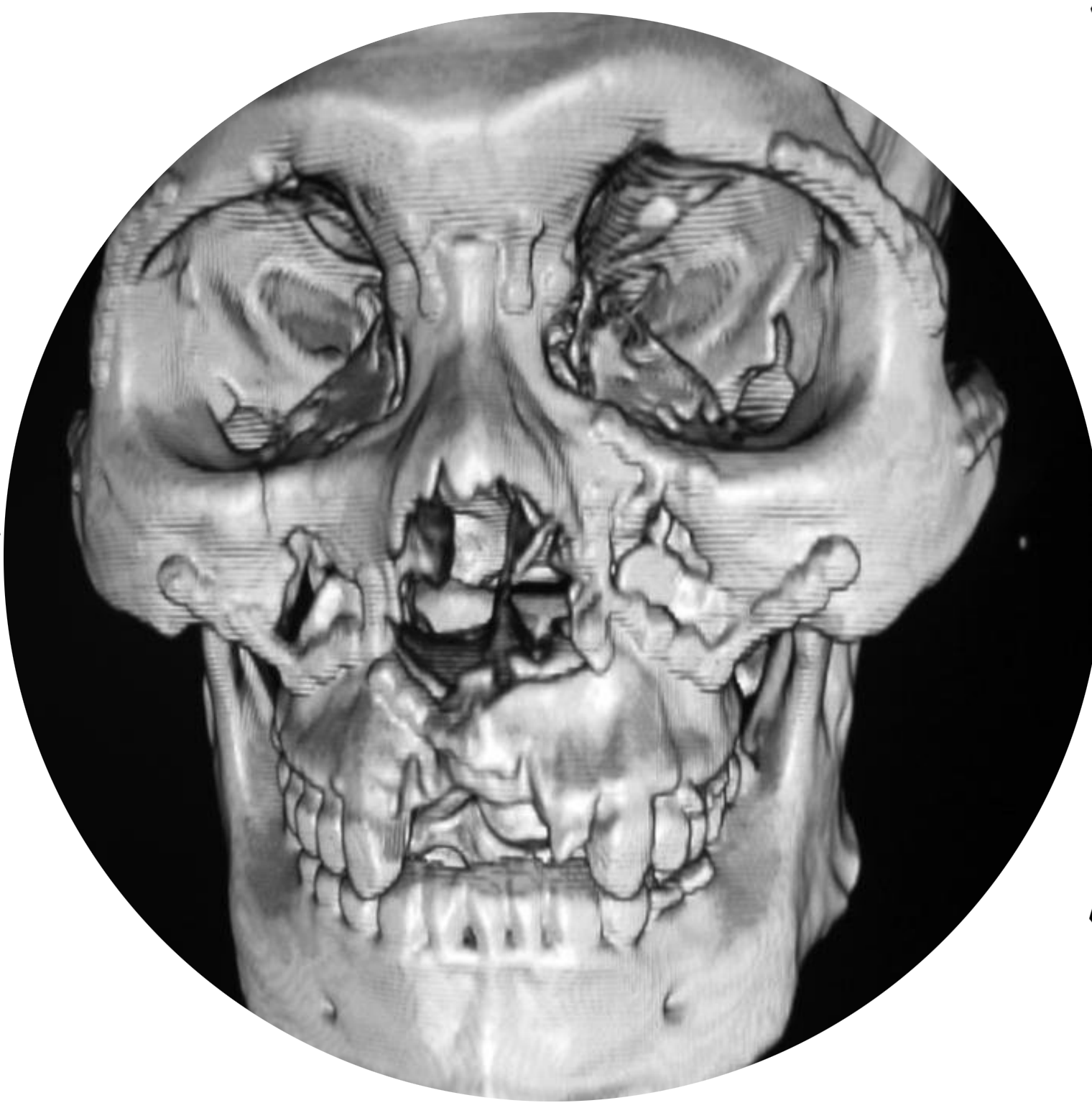 第3講 關(guān)于內(nèi)固定植入物核磁MRI、 CT、 X射線檢查