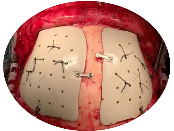 第2講 PEEK顱骨板的優(yōu)缺點(diǎn)分析