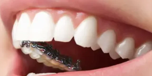 牙齒矯正，這是不是你關(guān)心的問題