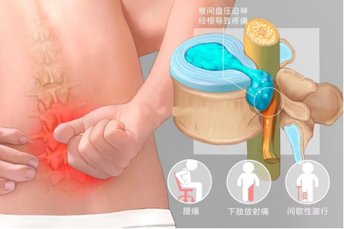 腰椎間盤(pán)突出.png