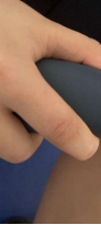 超聲波治療痛風(fēng)1.png