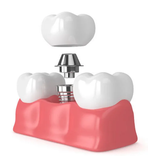 缺牙的影響你知道嗎