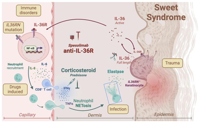 文獻速遞|急性發熱性中性粒細胞性皮炎新希望：靶向IL-36，Spesolimab顯效