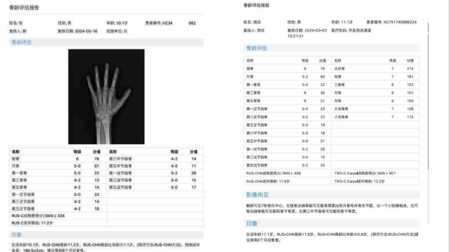 测骨龄是用什么仪器骨龄检测仪服务热线,骨龄检测仪