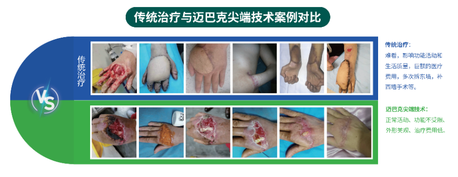 组织细胞原位再生修复难愈合伤口高新技术企业,原位再生修复