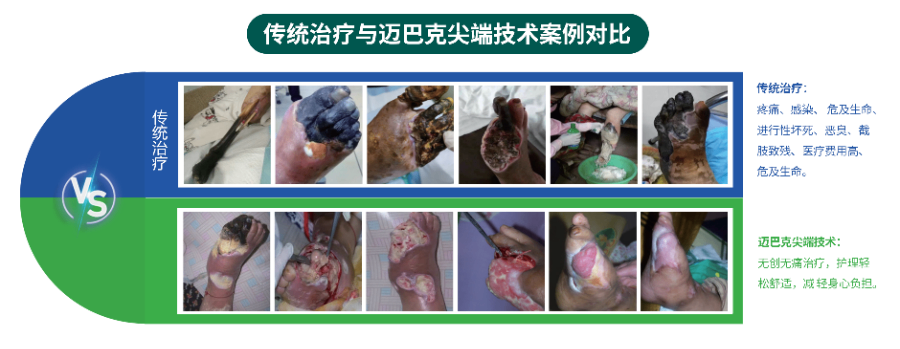 难愈合创面修复老烂腿医院进院,难愈合创面修复