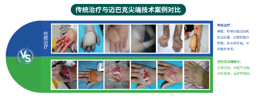 难愈合创面修复术后切口供应商,难愈合创面修复