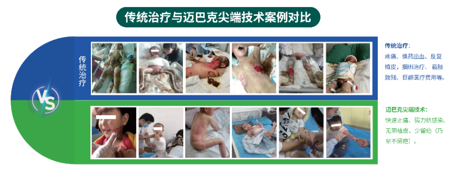 烧伤不皮瓣技术全愈禾膏,原位再生修复