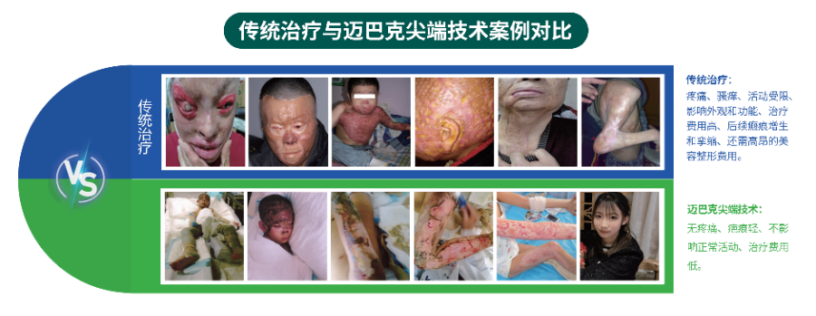 不植皮造口玉夫膏,原位再生修复