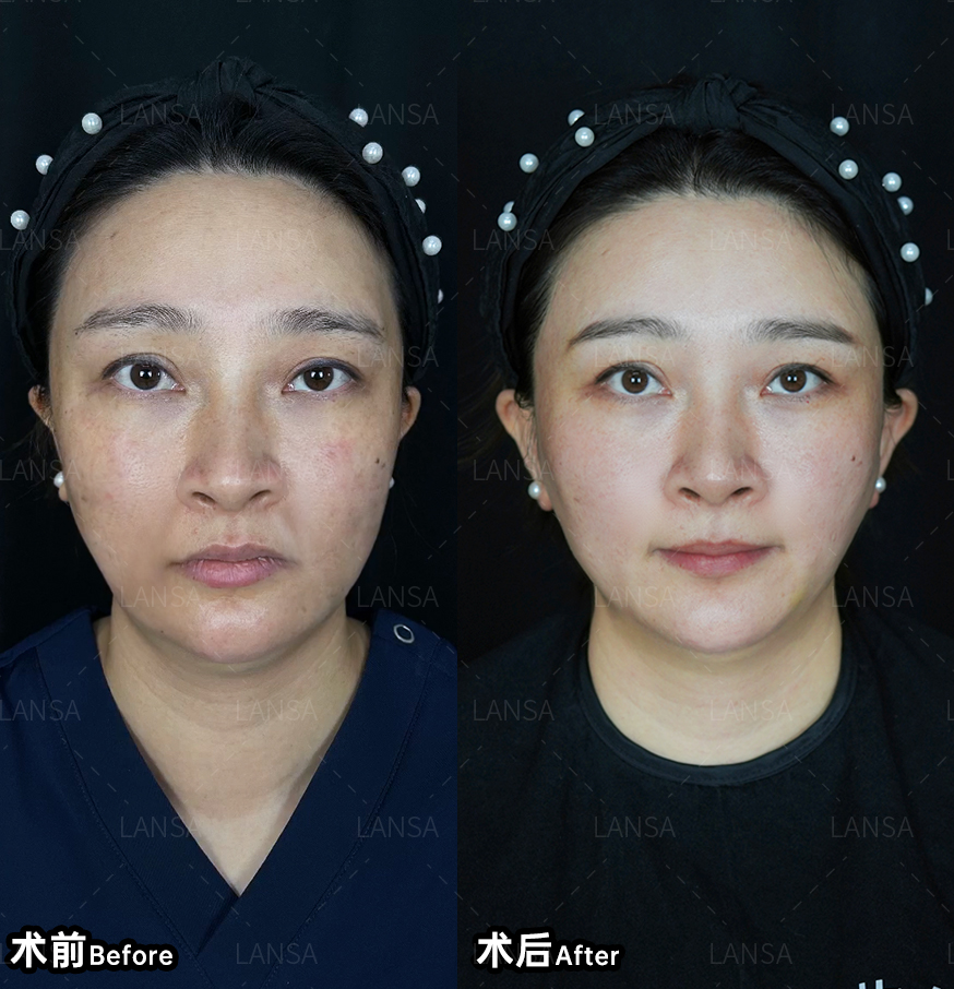 石家庄光电抗衰：蓝山整形NMPA认证设备测评