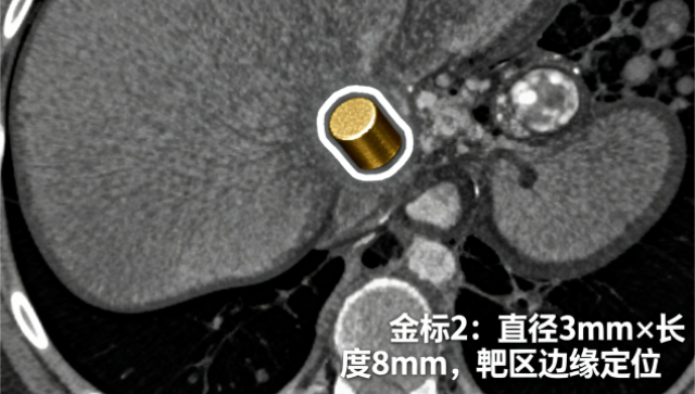 什么是精細(xì)放療（金標(biāo)）哪家強(qiáng) 南京萬(wàn)灃生物醫(yī)學(xué)供應(yīng)