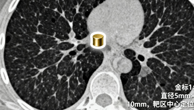 如何選精細放療（金標(biāo)）方案設(shè)計 南京萬灃生物醫(yī)學(xué)供應(yīng)