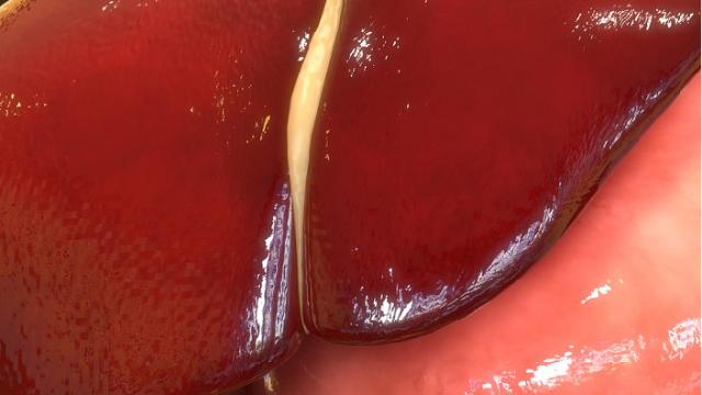 安徽質(zhì)量保膽取石解決方案銷售價格 南京萬灃生物醫(yī)學供應