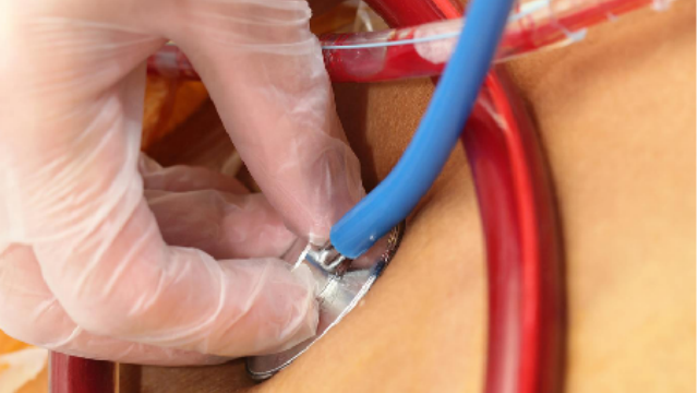 浙江發(fā)展結(jié)石臨床解決方案哪里有 南京萬灃生物醫(yī)學(xué)供應(yīng)