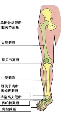 截肢部位的類型