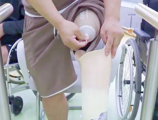浙江星源大腿假肢穿戴