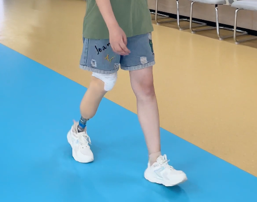 星源小腿假肢