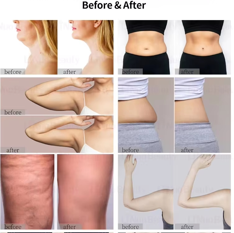 Desktop Coolwave Body Shaping Machine 2in1 ABS Cryoslim Cellulite Reduction and Sculpture Cryoskin Technology