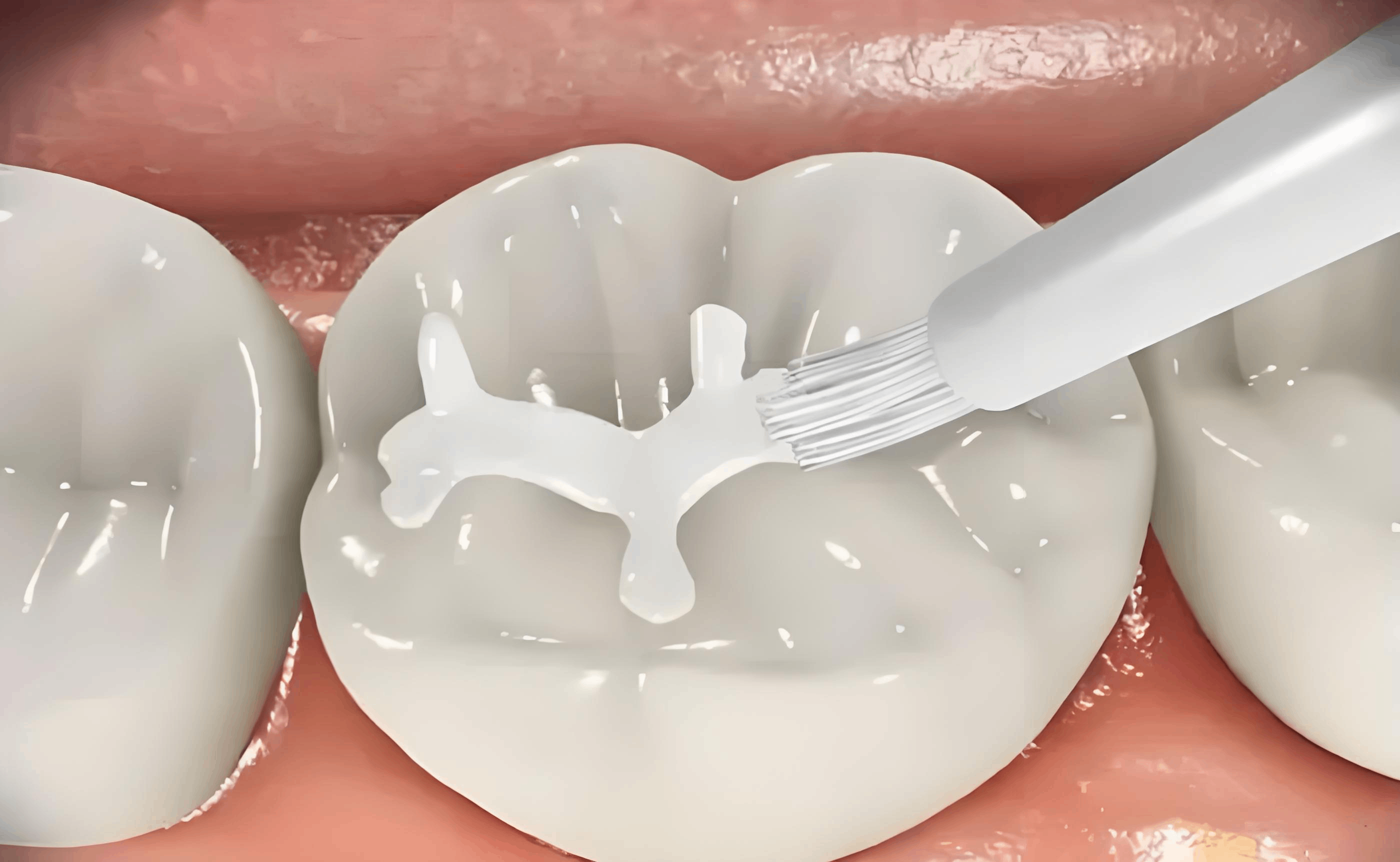 光固化補(bǔ)牙材料：現(xiàn)代牙科修復(fù)技術(shù)的革新