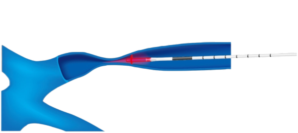 靜脈腔內激光消融系統