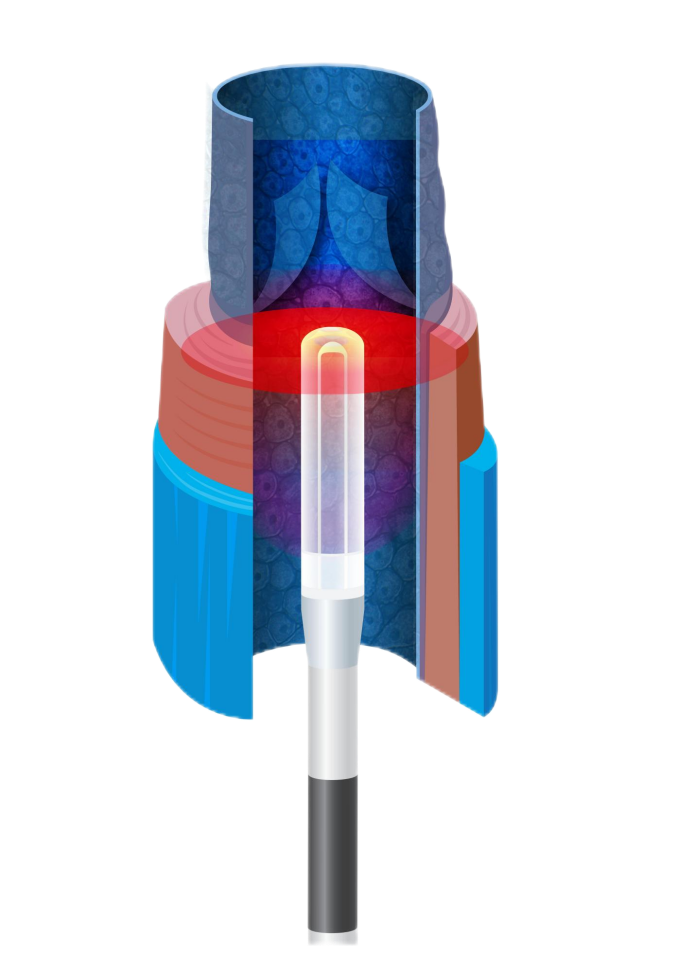 靜脈腔內激光消融系統
