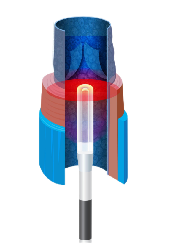 靜脈腔內激光消融系統