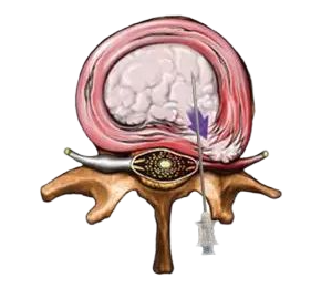 椎間盤激光消融修復系統