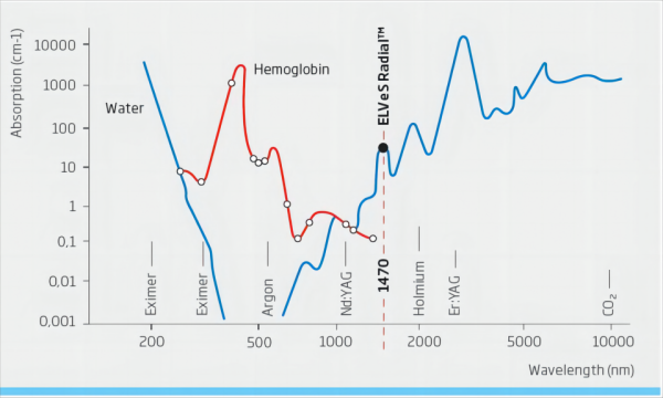 靜脈腔內激光消融系統