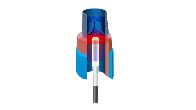 上海環(huán)狀光纖半導(dǎo)體激光治療儀腔內(nèi)安全熱消融 服務(wù)至上 上海優(yōu)福通醫(yī)療設(shè)備供應(yīng)