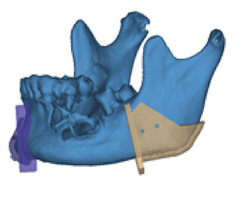 骨科定位器：提升手術準度的重要工具