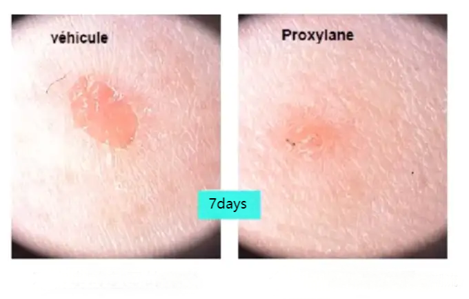 Pro-xylane wound healing