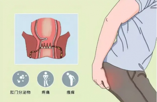 高位掛線肛瘺術后的痊愈 ——ATATA-愛氏抑菌液案肛瘺案例分享【四】