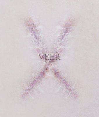 傷口植皮，疤痕問題怎么辦？